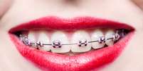 <p>Esse recurso além de disfarçar o uso, pois ninguém imagina que uma pessoa com aparelho use dentadura, ainda tende a rejuvenescer o paciente </p>  Foto: fotorince / Shutterstock