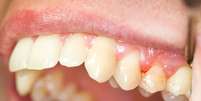 Sangramento na gengiva nem sempre indica periodontite, mas é um indício da necessidade de ouvir a opinião de um especialista  Foto: botazsolti / Shutterstock