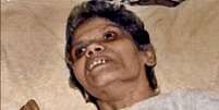 Aruna Shanbaug foi internada em um hospital de Mumbai em 1973 após ter sido vítima de um estupro  Foto: Twitter   