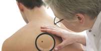 Pesquisa foi feita com 945 pacientes com melanoma avançado  Foto: BBC News Brasil