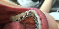 Colocados atrás dos dentes, em contato com a língua, o custo desse tipo de tratamento chega a ser até quatro vezes maior do que o feito com um aparelho convencional
  Foto: Divulgação