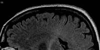 Portadores de Esclerose Lateral Amiotrófica (ELA) estão sem receber o medicamento Riluzol  Foto: Wikipédia