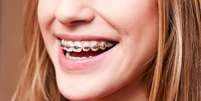 Com tratamento inovadores é possível tratar os dentes ainda em desenvolvimento e evitar aparelhos na adolescência e vida adulta  Foto: auleena / Shutterstock