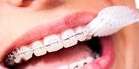 Para modificar a posição dos dentes, é preciso que ocorra um deslizamento entre os braquetes e o fio, o que não acontece se o aparelho estiver sujo  Foto: unpict / Shutterstock