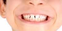 A formação dentária já se inicia na oitava semana de gestação   Foto: Veronica Louro / Shutterstock