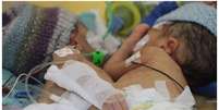 Lydia e Maya antes da sepração: uma tinha pressão alta, por ter muito sangue em circulação  Foto:  BBC / BBC News Brasil