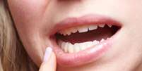 O autoexame da boca é fundamental para se detectar o aparecimento das lesões da hanseníase ou até de outras doenças. Fique atento!  Foto: Robert Kneschke / Shutterstock