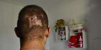 O adolescente Luís* levou um tiro nas costas e na cabeça após perseguição policial  Foto: Agência Brasil