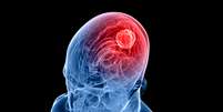 Nova droga mostrou-se 10 vezes mais potente que as existentes no tratamento de tumores cerebrais   Foto: iStock