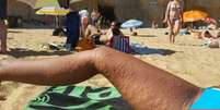 No verão, a brisa fresca da praia foi suficiente para encher de urticária o corpo de Beatriz Sánchez   Foto: Beatriz Sánchez / BBC News Brasil