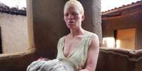 O albinismo é um distúrbio congênito caracterizado pela ausência de pigmento na pele, cabelos e olhos devido a uma deficiência na produção de melanina pelo organismo  Foto: BBC