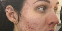Judith postou uma foto no Instagram antes de começar o tratamento com um medicamento controlado contra acne severa  Foto: Judith Donald / BBC News Brasil