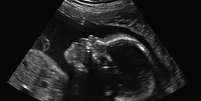 Ultrassonografia  Foto: BBC News Brasil