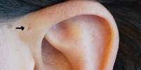 Já reparou se você mesmo, ou pessoas que conhece, têm um buraquinho no topo da cartilagem da orelha?  Foto: BBC News Brasil