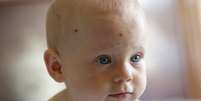 A vacina contra catapora evitou a internação de milhares de crianças americanas na última década  Foto: Getty Images / BBC News Brasil