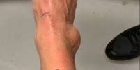 Neymar divulga inchaço do tornozelo direito  Foto: Reprodução/Instagram / Estadão