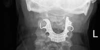 Médicos encontraram dentadura de homem em sua garganta oito dias após cirurgia no abdômen  Foto: BMJ Case Reports 2019 / BBC News Brasil