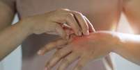Pessoas com dermatilomania podem beliscar ou arranhar manchas, sardas, marcas ou cicatrizes para "suavizar" ou "ajeitá-las"  Foto: Getty Images / BBC News Brasil