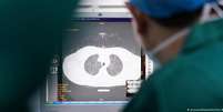 "Em alguns pacientes, a função pulmonar pode cair de 20% a 30% após a cura", afirma médico de Hong Kong  Foto: DW / Deutsche Welle