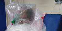 Paciente respira com um saco plástico improvisado por falta de equipamento em Manaus  Foto: Twitter/Reprodução / Estadão