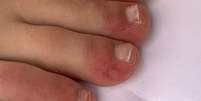 'Dedos de covid' foi um dos sintomas observados  Foto: COVID-piel study / BBC News Brasil