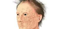 Muitos dos pacientes de varíola ficavam com cicatrizes terríveis no rosto e no corpo  Foto: Getty Images / BBC News Brasil