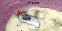 A imagem mostra um axônio de um neurônio do cérebro de uma criança com síndrome inflamatória multissistêmica pediátrica (SIM-P). A seta aponta o vírus SARS-CoV-2 em uma vesícula no citoplasma do axônio  Foto: Elia Caldini / BBC News Brasil