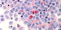 Tratamento prevê que células são coletadas para serem alteradas com um novo gene  Foto: Instituto Nacional do Câncer / Divulgação / Estadão