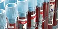 Entenda a nova variante do HIV  Foto: Shutterstock / Saúde em Dia