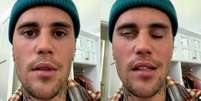 Justin Bieber em vídeo publicado no perfil do artista nesta sexta, 10. Ele disse que está com parte do rosto paralisado por conta da síndrome de Ramsay Hunt.  Foto: Instagram/@justinbieber / Estadão