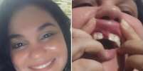 Andressa Hailer teve dentes quebrados e freio costurado na gengiva durante cirurgia  Foto: Reprodução/Arquivo pessoal