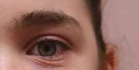 Rinite: pregas abaixo dos olhos está entre os sintomas da alergia  Foto: Shutterstock / Saúde em Dia
