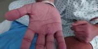 Homem mostra sintomas da varíola dos macacos nas mãos | Foto ilustrativa   Foto: Reuters