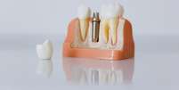 A colocação de um implante dental é um procedimento cada vez mais comum   Foto: Pexels