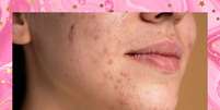 Veja as diferenças entre acne e rosácea  Foto: Freepik / todateen