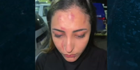 Soraya Oliveira mostra hematomas após sofrer agressão   Foto: TV Jornal