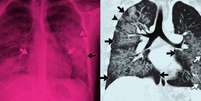 Imagem de raio X e tomografia computadorizada de paciente com lesões (setas brancas e pretas) provocadas pelo uso de cigarros eletrônicos   Foto: Sociedade de Radiologia da América do Norte