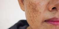 Melasma: máscara facial reduz as manchas escuras  Foto: Shutterstock / Saúde em Dia