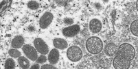 Análise genômica remonta existência do vírus da varíola há mais de 3.000 anos  Foto: Poder360