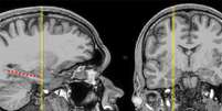 Ressonância magnética mostrando locais de eletrodos medial-temporais em um paciente representativo  Foto: Departamento de Cirurgia Neurológica, Universidade de Chicago