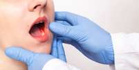 Câncer de boca: sintomas, causas, diagnóstico e tratamento  Foto: Shutterstock / Saúde em Dia