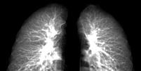Pesquisadores criaram um modelo avançado de raio-x que pode detectar danos pulmonares em pacientes com covid longa   Foto: 