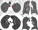 Enfisema pulmonar em (A, B) fumantes de maconha e (C, D) fumantes de tabaco.  Foto: Murtha et al., Radiology, 2022