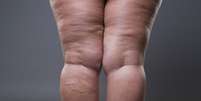 Lipedema: saiba o que causa o acúmulo de gordura no corpo  Foto: Saúde em Dia