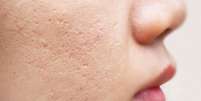 Cicatrizes de acne cuidados  Foto: Shutterstock / Alto Astral