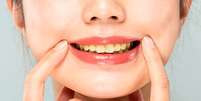 Alimentos amarelam dentes  Foto: Shutterstock / Alto Astral