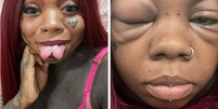 A jamaicana está acostumada a fazer modificações corporais, como bifurcação da língua e tatuagens, e compartilha seu estado de saúde através do TikTok  Foto: Reproução/ TikTok: @inkedup_britishjamaican1