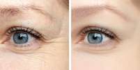 Como evitar rugas e outros problemas na região dos olhos?  Foto: Shutterstock / Saúde em Dia