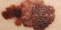 Pinta t&iacute;pica de um melanoma  Foto: Getty Images / BBC News Brasil