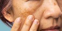 Melasma: sol do verão pode causar manchas escuras na pele  Foto: Shutterstock / Saúde em Dia